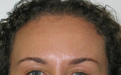 Botox forehead
