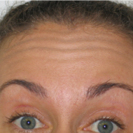 Botox forehead